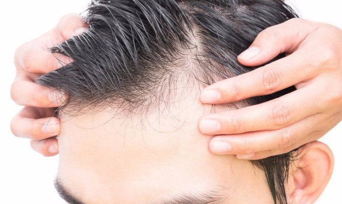 Τριχόπτωση – Φαλάκρα: Τι επιλογές υπάρχουν για φυσική αναγέννηση μαλλιών
