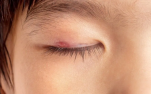 Κριθαράκι στο μάτι: Αίτια, πρόληψη & αντιμετώπιση