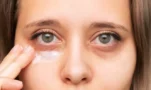 Μαύροι κύκλοι κάτω από τα μάτια: Αιτίες και λύσεις – Τι ιατρικές θεραπείες υπάρχουν